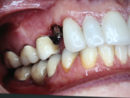 Implant by Mark Dennis,DDS