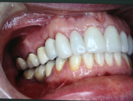 Implant crown by Mark Dennis,DDS