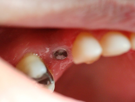 cosmetic dental bridge by Mark Dennis, DDS