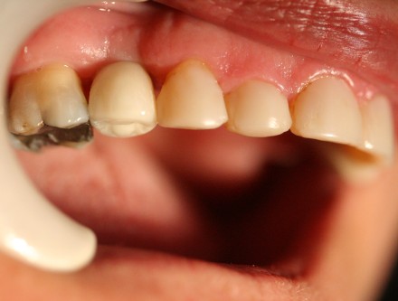 cosmetic dental bridge by Mark Dennis, DDS
