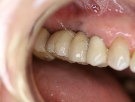 implant reconstruction by Mark Dennis, DDS