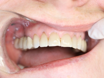 Implant bridge by Mark Dennis,DDS