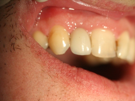 implant reconstruction by Mark Dennis, DDS