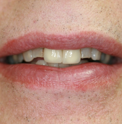 failing crowns not by Mark Dennis,DDS