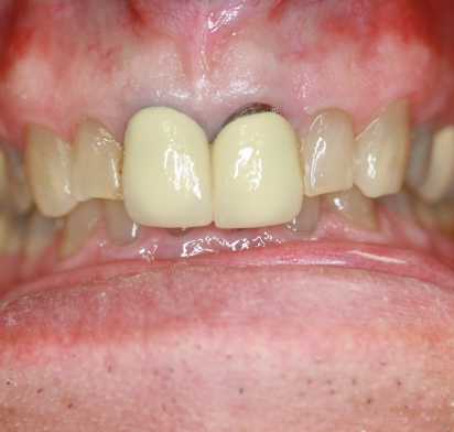 crowns not by Mark Dennis, DDS