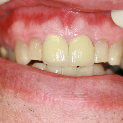 Implant reconstruction by Mark Dennis,DDS