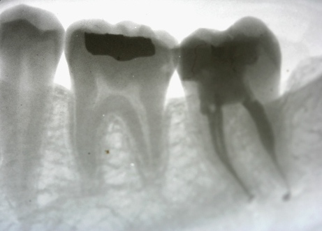 Root Canal by Mark Dennis,DDS
